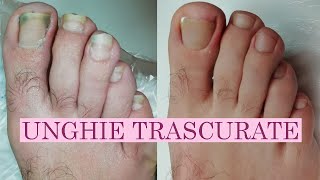 Pedicure unghie trascurate incarnite e onicolisi [upl. by Elberfeld81]