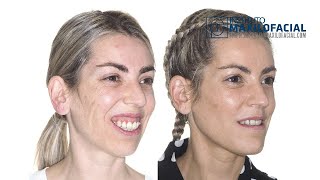 Jaw surgery Case  85 Marjorie Class II gummy smile biprotrusion [upl. by Halland744]