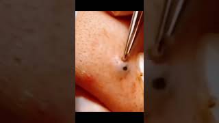 Dilated pore of Winer pimple extraction popping skincare cyst whiteheads blackheads [upl. by Tillford]