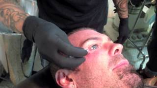 Rich Piana getting dermal implant removed [upl. by Broddie]