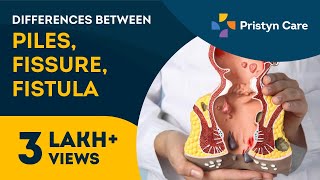 Differences Between Piles Fissures and Fistula in Tamil  For Free Appointment Call on 6366526460 [upl. by Apollus]