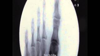 Bilateral Akin Osteotomy Hammertoe Correction With XRays [upl. by Ahsatan249]