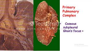 Primary Pulmonary Tuberculosis [upl. by Silin321]