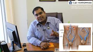 Varicocele Embolization vs Microsurgery in Hindi  Varicocele Embolization ke Nuksan aur Failure [upl. by Eyaj43]