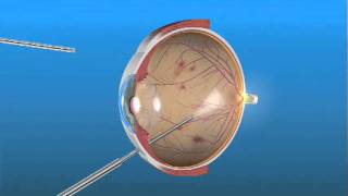 Cirugía de Vitrectomía para Retinopatía Diabética [upl. by Hortensa]