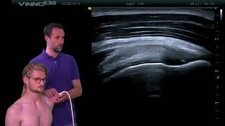 Demonstratie echografie supraspinatus lengte opname [upl. by Palecek257]