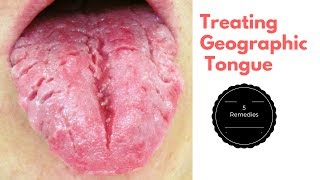 Top 5 Home Remedies for Treating Geographic Tongue [upl. by Lorilee]