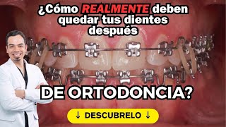 ¿Cómo realmente🧐 DEBEN QUEDAR TUS DIENTES DESPUÉS DE LA ORTODONCIA [upl. by Initirb913]