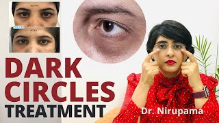 Dark circles Dark circles treatment Undereye dark circles cream  Dark circle home remedies [upl. by Anitsirhc561]