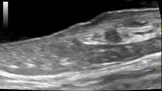 Sonography of distal ureter ureteral papilla and ureteral jet in a dog with pyelonephritis [upl. by Aznarepse692]