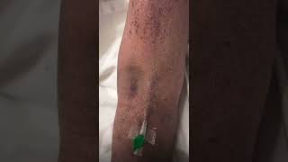 IV cannula insertioncannulationnursingshortvideo [upl. by Ali]