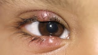 how to get rid of a stye overnight [upl. by Acireed]