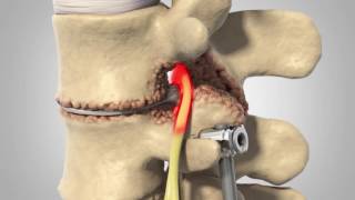 Adjacent Segment Disease  Patient Animation [upl. by Aneladdam]