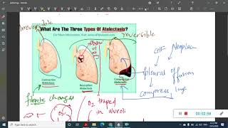 pulmonary edema  Pathology [upl. by Shimberg]