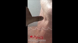 Normal Carotid Pulse Narrated [upl. by Oiralih]