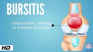 Bursitis Causes Signs and Symptoms Diagnosis and Treatment [upl. by Ellesij]