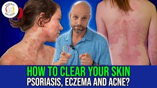 How To Clear Your Skin Eczema Psoriasis Acne [upl. by Ecallaw207]