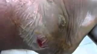 Big Blackhead Squeezed Pimple Removal Cyst Treatment 2015 [upl. by Yeaton]