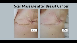 scar massage after breast cancer mastectomy lumpectomy and diep flap [upl. by Ailedamla]