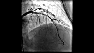 Acute anterior wall myocardial infarction [upl. by Mills929]