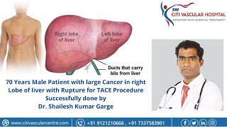 Live TACE Procedure Live TransArterial ChemoEmbolization Liver HCC TACE Liver Cancer TACE [upl. by Lyreb555]