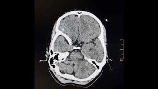 leptomeningeal cysts [upl. by Aret143]