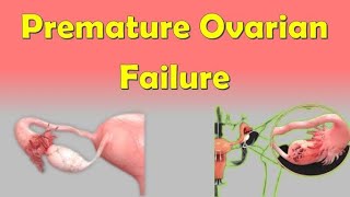 Premature Ovarian Failure Causes Symptoms Diagnosis and Treatment [upl. by Bandler]