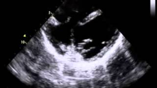 abnormal tricuspid chord in Turner syndrome [upl. by Romulus543]