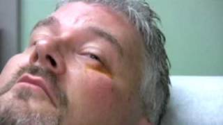 Chalazion Injection Demonstration [upl. by Ettegroeg]