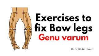 Exercises to fix Bow legs  Genu varum [upl. by Rakabuba331]