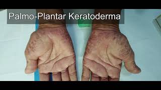 Palmoplantar Keratoderma [upl. by Yelkao932]