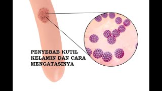 podofilox condylox cream perontok kutil kelamin hpv [upl. by Nnorahs]