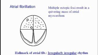 ECG Atrial Fibrillation [upl. by Estus]