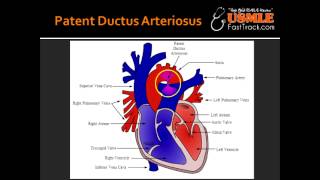 Patent Ductus Arteriosus [upl. by Nehr]