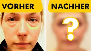 Tränensack Entfernung  Vorher amp Nachher Bilder im Vergleich  Dr Jungwirth  Plastische Chirurgie [upl. by Malvino]