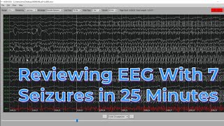 EEG with 7 seizures in 25 minutes [upl. by Odlaumor]