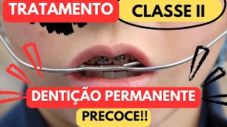 Como deve ser realizado o tratamento da Classe II com AEB na dentição PERMANENTE Aula 194 [upl. by Noli]