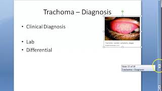 Ophthalmology 076 e Trachoma Lab Diagnosis Differential Differentiate from Viral and Vernal [upl. by Imyaj]