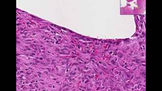 Histopathology ElbowChronic fibrinous bursitis [upl. by Ytok]