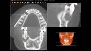 AOT Adenomatoid Odontogenic Tumor confirmed [upl. by Dachi]