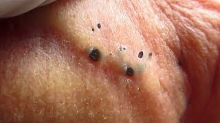 Ear Blackheads of Year Best Blackheads of 2018 [upl. by Viridissa]