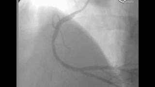 angioplastia en Infarto Agudo [upl. by Etac]