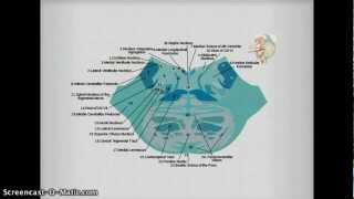 Medial Inferior Pontine Syndrome pics [upl. by Stretch]