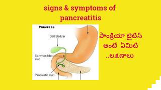 signs and symptoms of pancreatitis పాంక్రియాస్ లక్షణాలు [upl. by Chauncey]