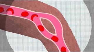 Sickle Cell Anaemia Explained [upl. by Kayle]