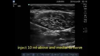 tibial nerve block new approach [upl. by Lecram]