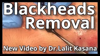 Blackhead Removal by DrLalit Kasana [upl. by Udell]