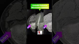 Osteoid Osteoma Microwave Ablation microwave irad pinhole cancer surgery cancerawareness [upl. by Nairb]