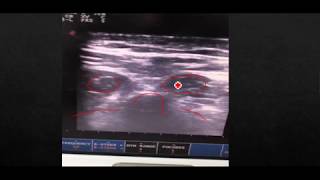 Paraspinal needle Electromyography testing procedure [upl. by Haret]