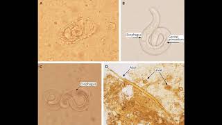 Strongyloides stercoralis  morphology life cycle pathogenesis diagnosis and treatment [upl. by Farrow]